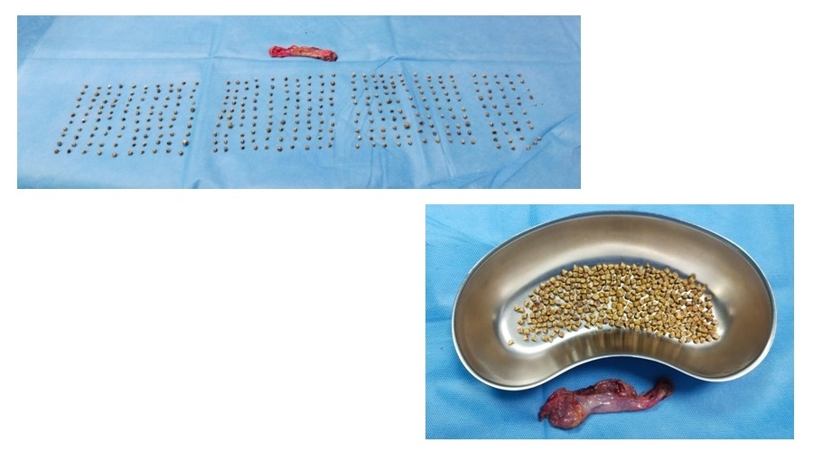 Surgical Milestone: Surgeons at Aster RV Hospitals Achieve Milestone with Removal of 345 Gallstones